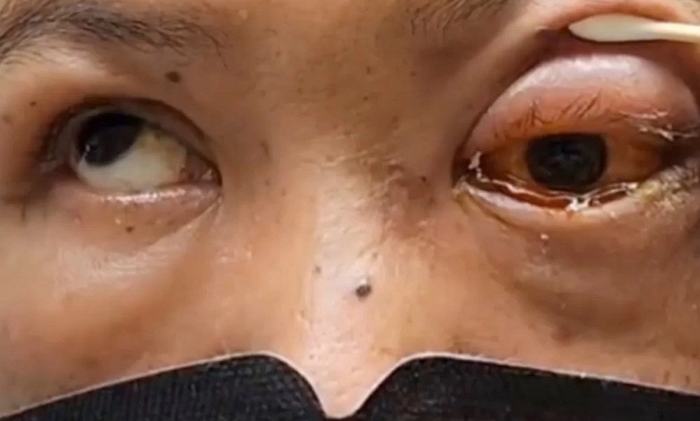 Homem fica cego de um olho após adormecer bêbado e de bruços; veja vídeo